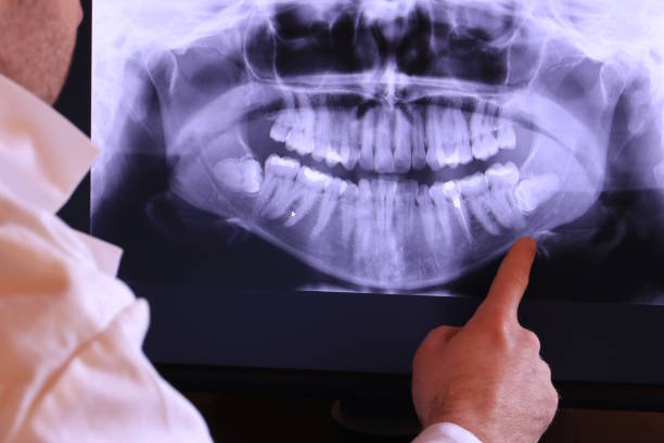 Best Emergency Wisdom Tooth Extraction in Hope, AR